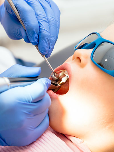 fillings