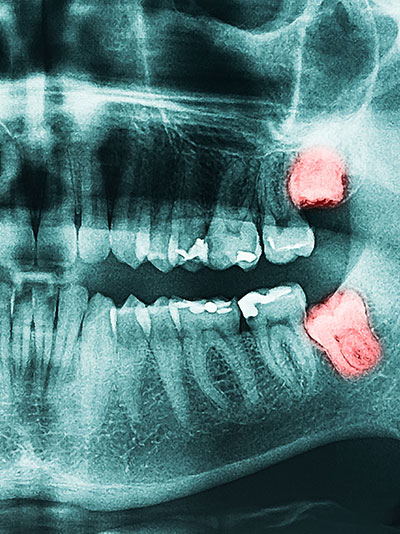 oral surgery