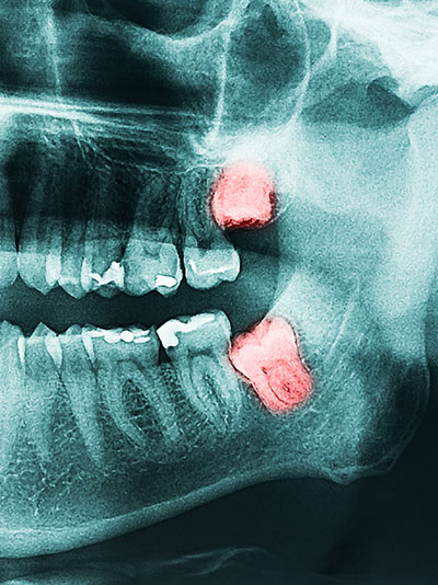 wisdom teeth